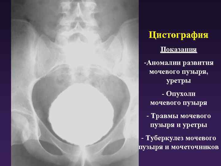 Цистография Показания -Аномалии развития мочевого пузыря, уретры - Опухоли мочевого пузыря - Травмы мочевого