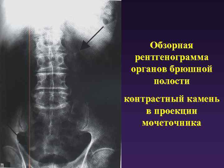 Обзорная рентгенограмма органов брюшной полости контрастный камень в проекции мочеточника 