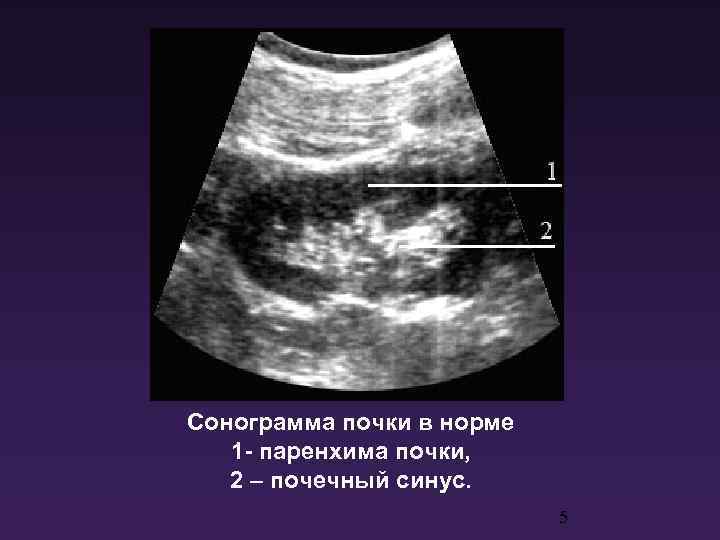 Сонограмма почки в норме 1 - паренхима почки, 2 – почечный синус. 5 