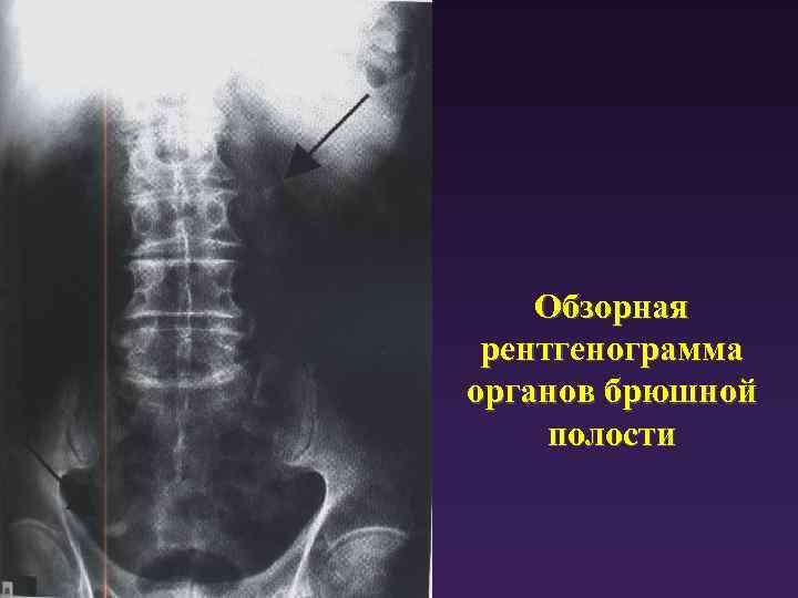 Обзорная рентгенограмма органов брюшной полости 