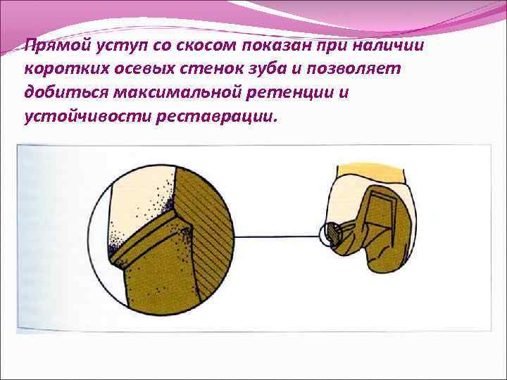 Прямой уступ со скосом показан при наличии коротких осевых стенок зуба и позволяет добиться