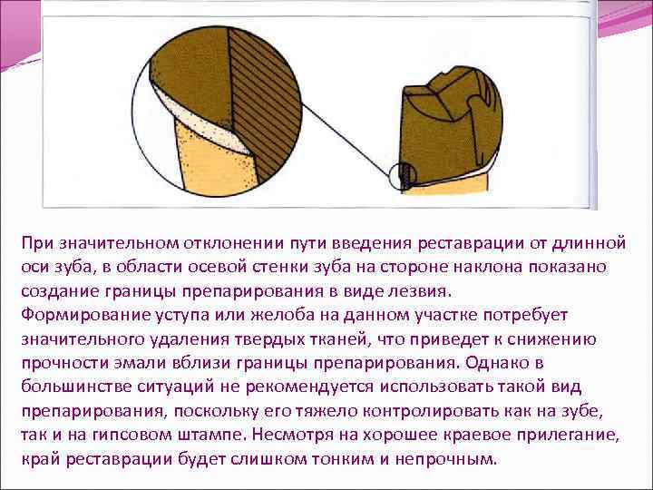 При значительном отклонении пути введения реставрации от длинной оси зуба, в области осевой стенки