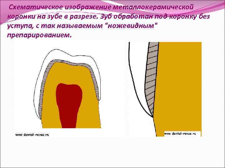  Схематическое изображение металлокерамической коронки на зубе в разрезе. Зуб обработан под коронку без