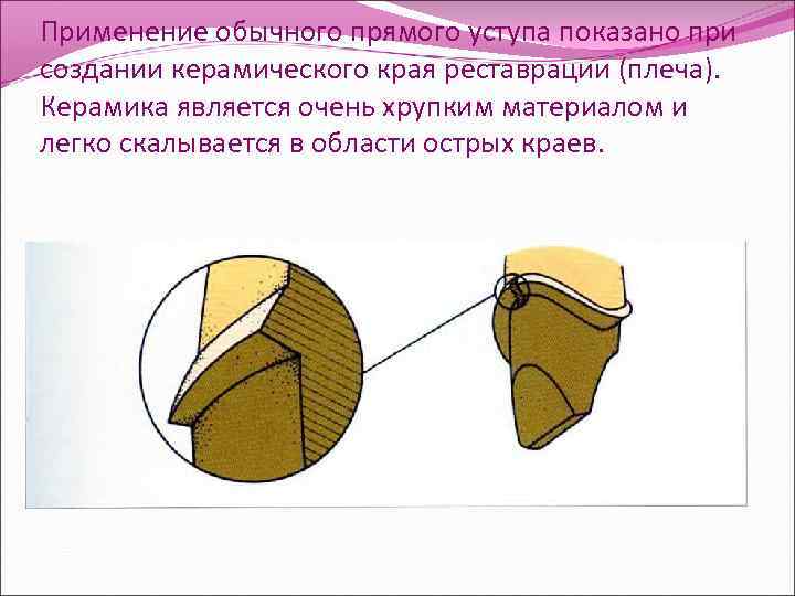 Применение обычного прямого уступа показано при создании керамического края реставрации (плеча). Керамика является очень