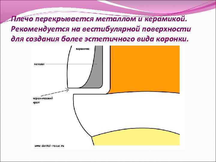 Плечо перекрывается металлом и керамикой. Рекомендуется на вестибулярной поверхности для создания более эстетичного вида