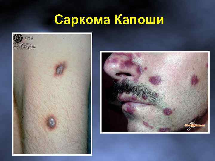 Саркома Капоши 