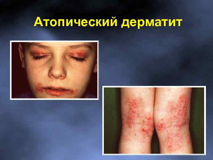 Атопический дерматит 