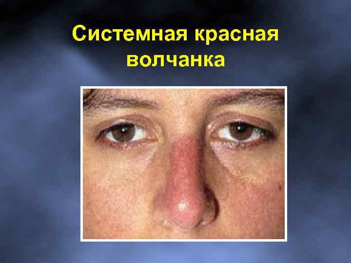 Системная красная волчанка 