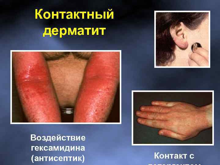 Контактный дерматит Воздействие гексамидина (антисептик) Контакт с 