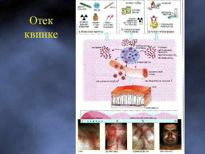 Отек квинке 