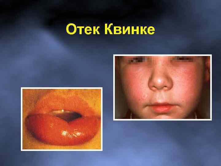 Отек Квинке 