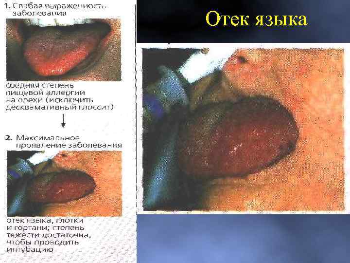 Отек языка 