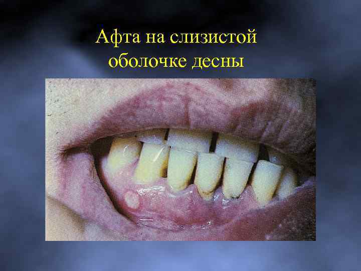 Афта на слизистой оболочке десны 