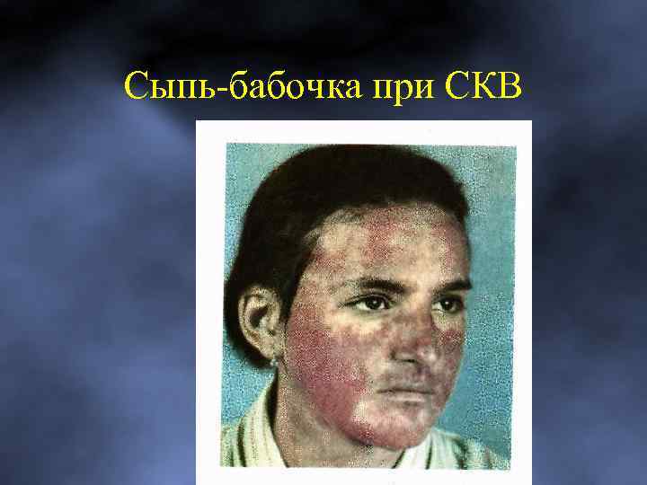 Сыпь-бабочка при СКВ 