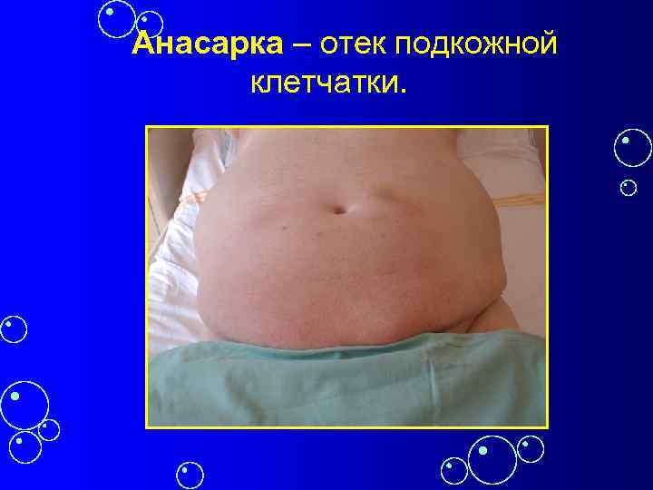 Анасарка – отек подкожной клетчатки. 