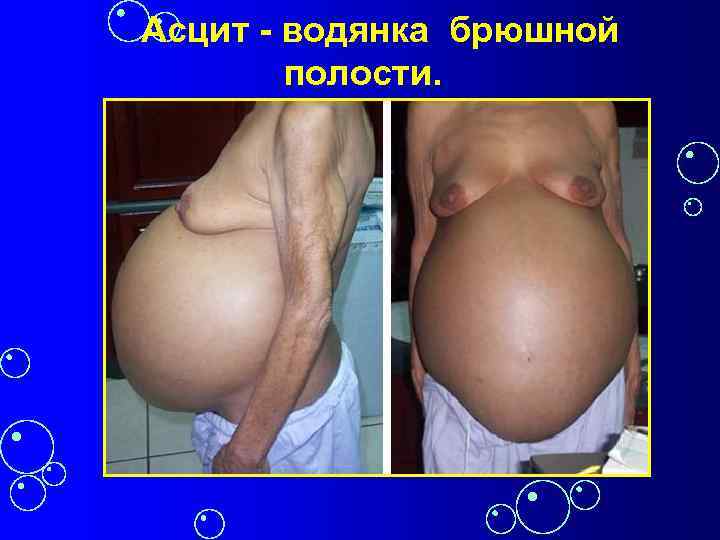 Асцит - водянка брюшной полости. 