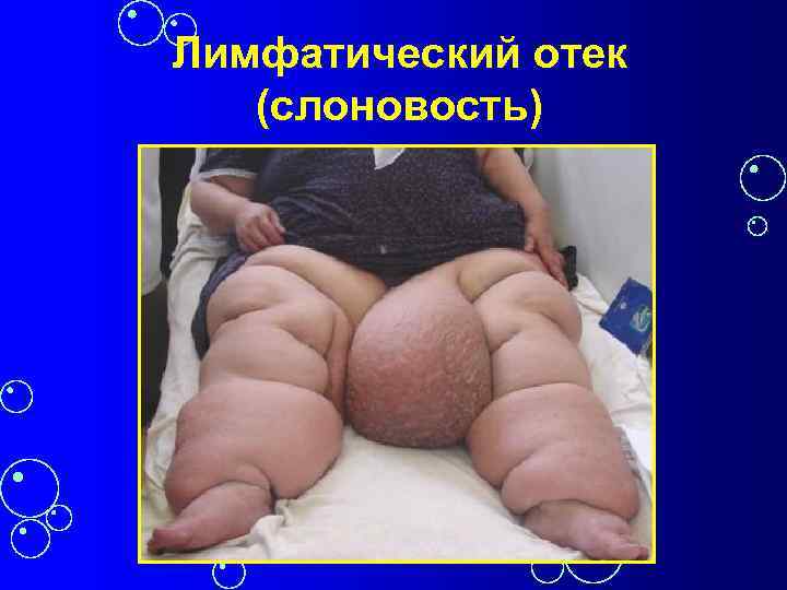 Лимфатический отек (слоновость) 