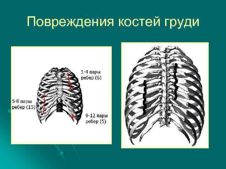 Повреждения костей груди 