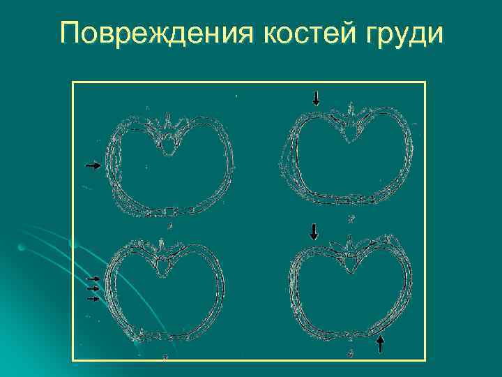 Повреждения костей груди 