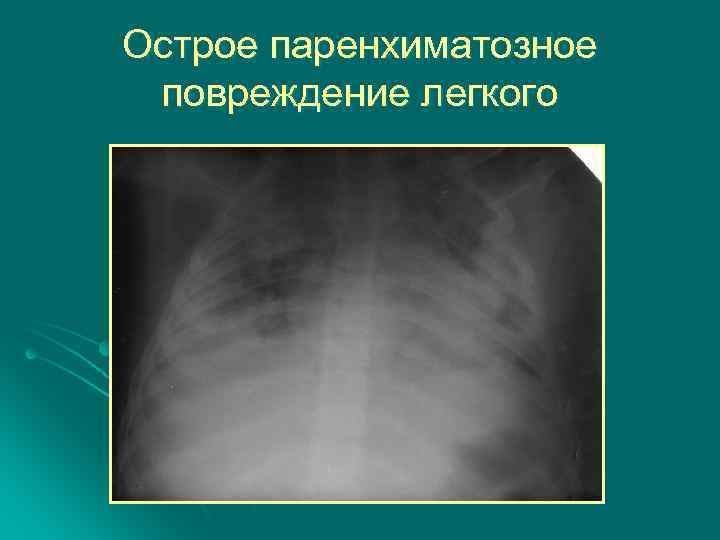 Острое паренхиматозное повреждение легкого 