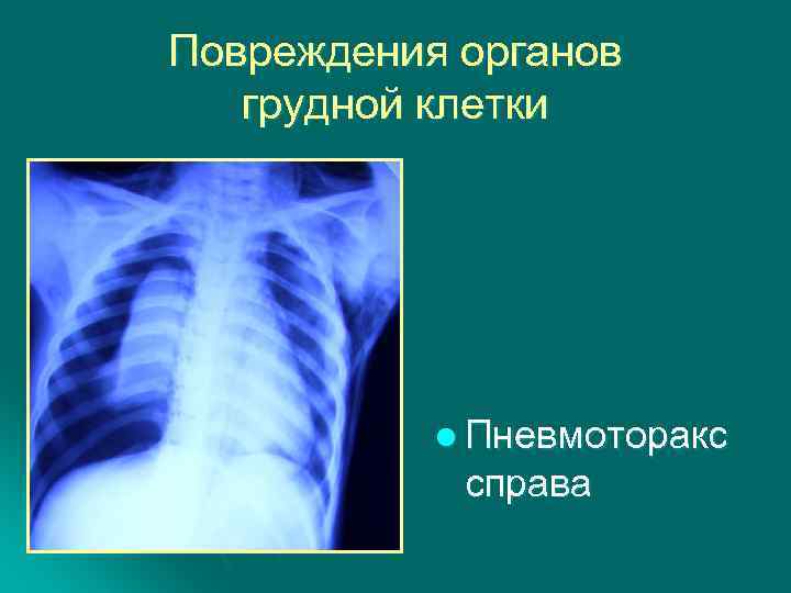 Картинки травма грудной клетки