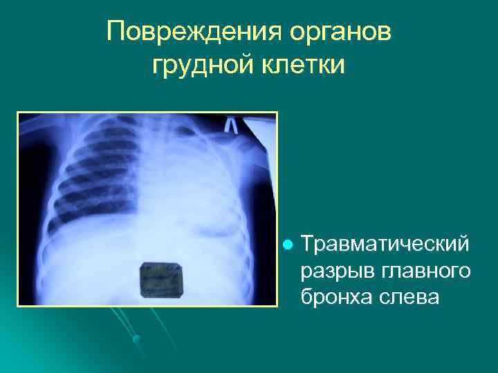 Повреждение органов. Повреждение органов грудной клетки. Травматические повреждения органов грудной клетки. Ушиб органов грудной клетки. Закрытая травма органов грудной клетки.