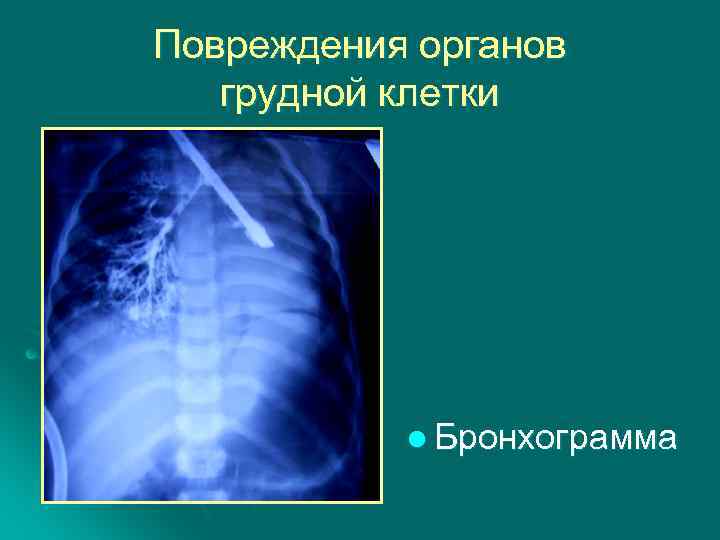 Повреждения органов грудной клетки l Бронхограмма 