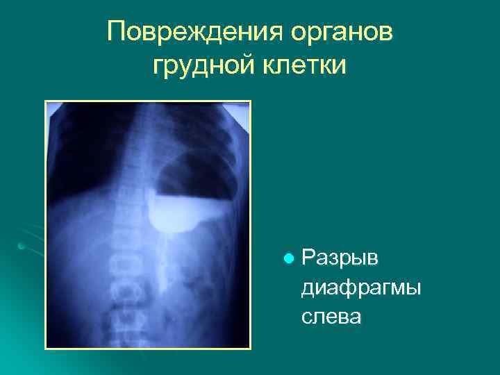 Повреждение органов. Травматические повреждения диафрагмы. Разрыв диафрагмы рентген. Повреждение диафрагмы симптомы. Травмы диафрагмы разрыв.