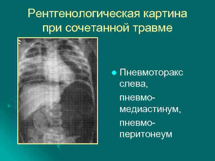 Рентгенологическая картина при сочетанной травме l Пневмоторакс слева, пневмомедиастинум, пневмоперитонеум 