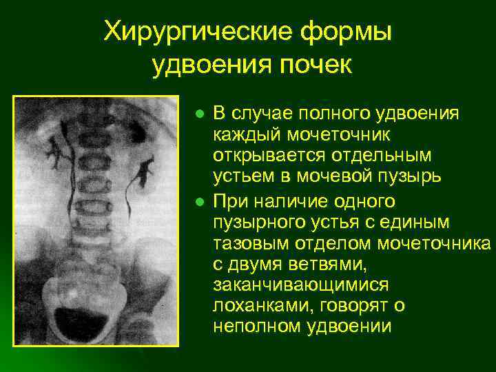 Гидронефроз презентация детская хирургия