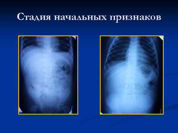 Приобретенная кишечная непроходимость у детей презентация