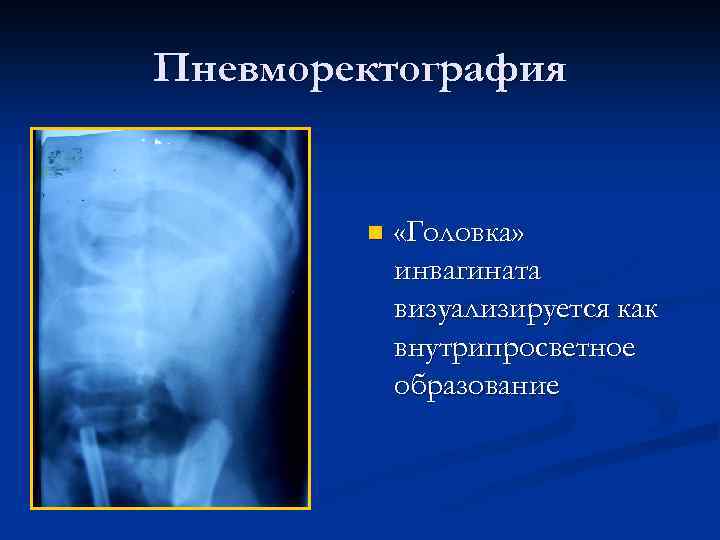 Пневморектография n «Головка» инвагината визуализируется как внутрипросветное образование 