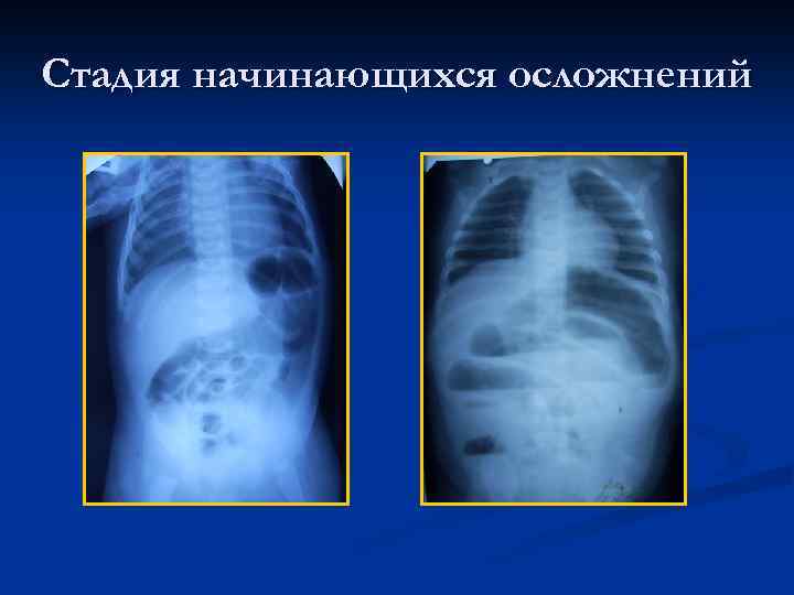 Приобретенная кишечная непроходимость у детей презентация