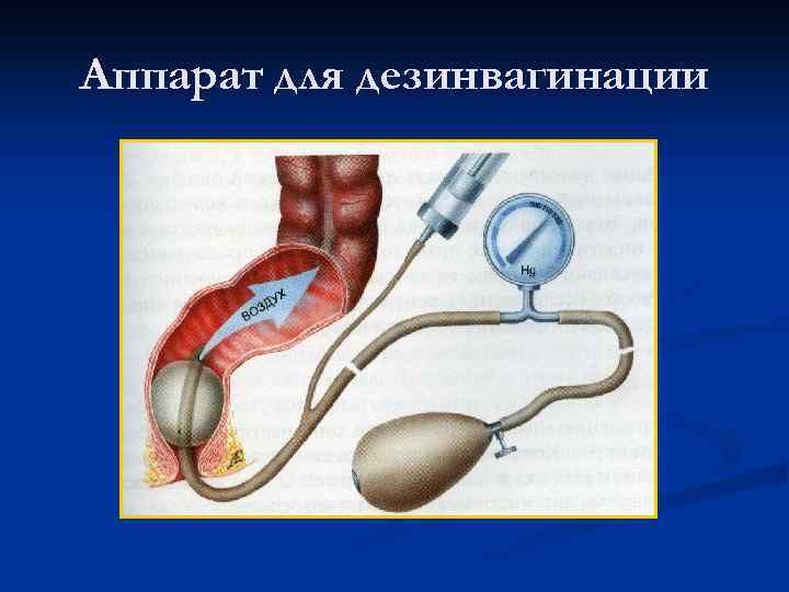 Аппарат для дезинвагинации 