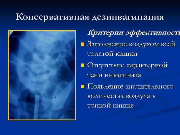 Консервативная дезинвагинация Критерии эффективности Заполнение воздухом всей толстой кишки n Отсутствие характерной тени инвагината