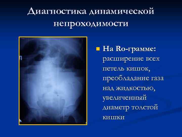 Диагностика динамической непроходимости n На Ro-грамме: расширение всех петель кишок, преобладание газа над жидкостью,