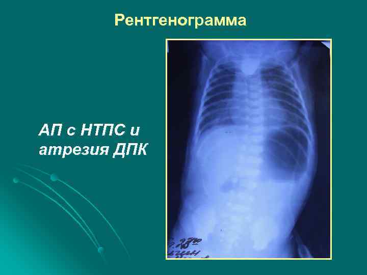 Рентгенограмма АП с НТПС и атрезия ДПК 