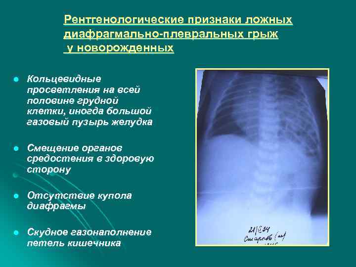 Рентгенологические признаки ложных диафрагмально-плевральных грыж у новорожденных l Кольцевидные просветления на всей половине грудной