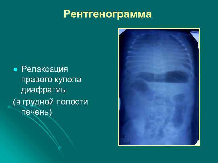 Рентгенограмма Релаксация правого купола диафрагмы (в грудной полости печень) l 