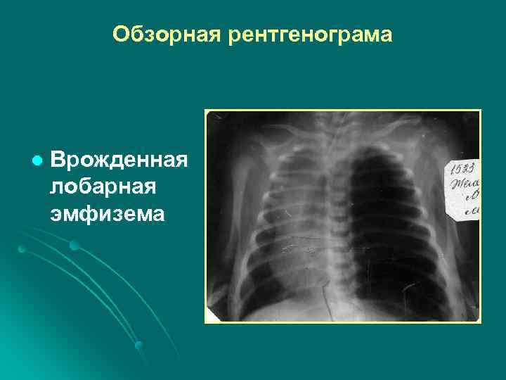 Обзорная рентгенограма l Врожденная лобарная эмфизема 