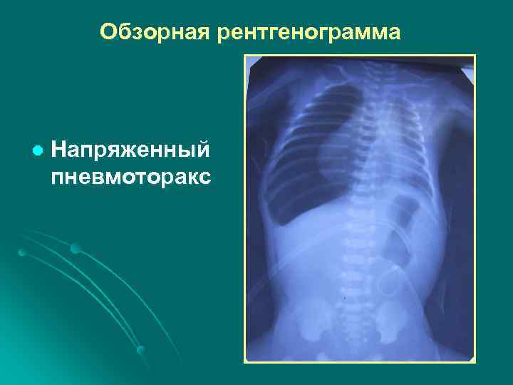 Обзорная рентгенограмма l Напряженный пневмоторакс 