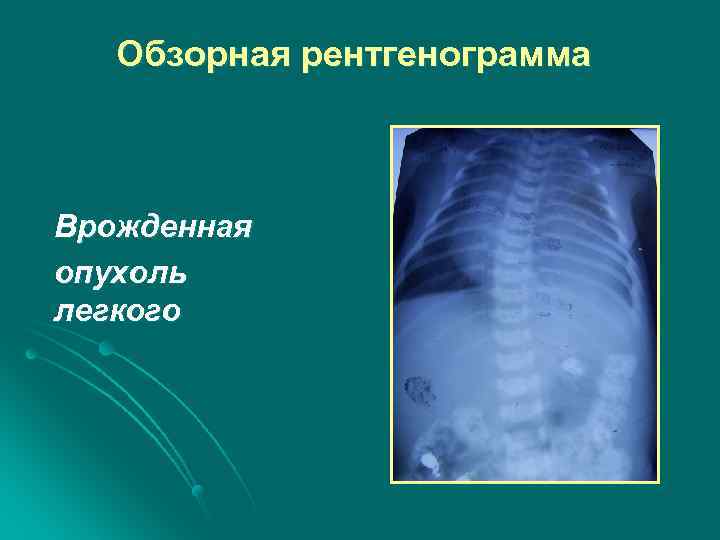 Обзорная рентгенограмма Врожденная опухоль легкого 