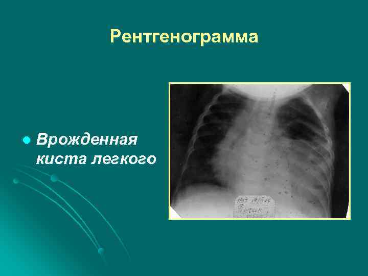 Киста легкого. Врождённые кисты лёгких. Врожденная киста легкого. Врожденная киста легкого у детей. Врожденная киста легких рентген.