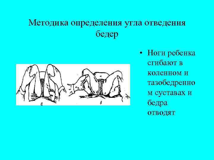 Методика определения угла отведения бедер • Ноги ребенка сгибают в коленном и тазобедренно м