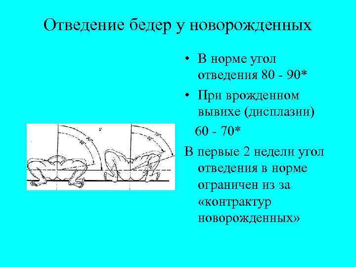 Отведение бедер у новорожденных • В норме угол отведения 80 - 90* • При