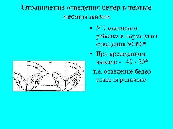 Ограничение отведения бедер в первые месяцы жизни • У 7 месячного ребенка в норме