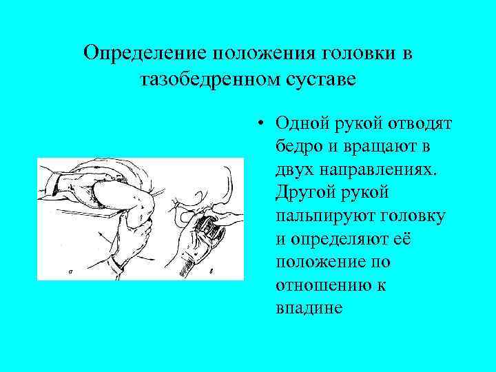 Определение положения головки в тазобедренном суставе • Одной рукой отводят бедро и вращают в