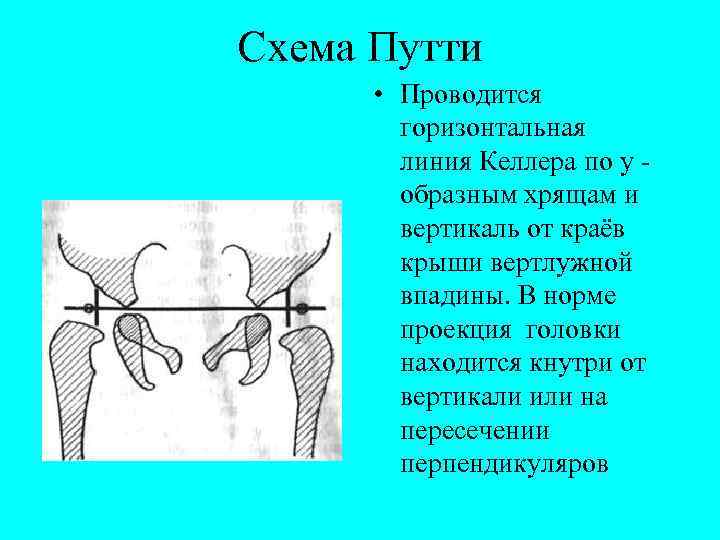 Схема Путти • Проводится горизонтальная линия Келлера по y образным хрящам и вертикаль от