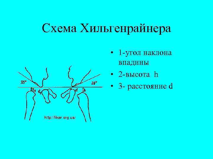 Схема Хильгенрайнера • 1 -угол наклона впадины • 2 -высота h • 3 -