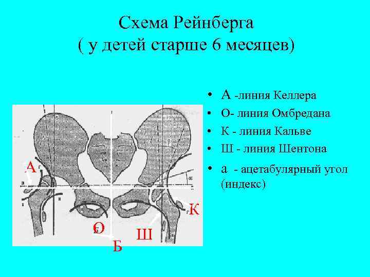 Схема врожденного вывиха бедра